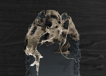 UQ and LEO Pharma collaborate on skin cancer treatment UQ and LEO Pharma collaborate on skin cancer treatment