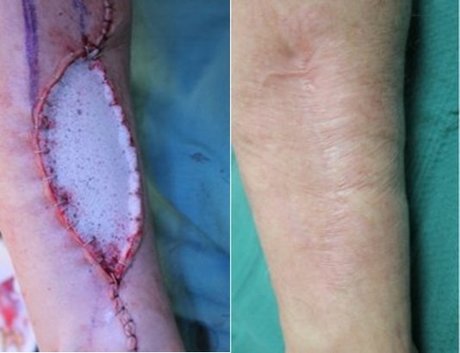Strong results from PolyNovo's NovoSorb BTM trial Strong results from PolyNovo's NovoSorb BTM trial