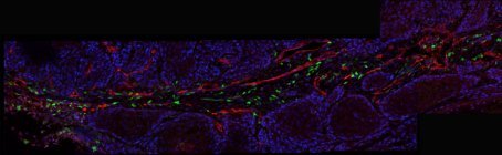 Managing the cancer microenvironment