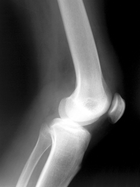 Stem cell trial for knee osteoarthritis underway Stem cell trial for knee osteoarthritis underway