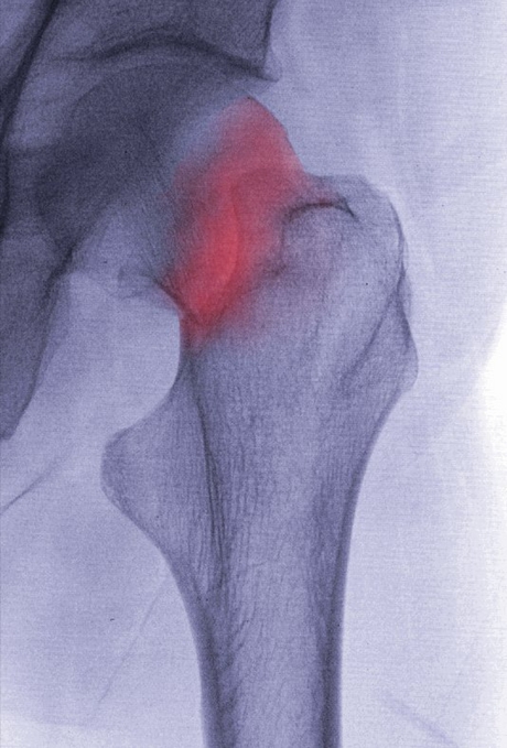 A gene associated with osteoporosis A gene associated with osteoporosis