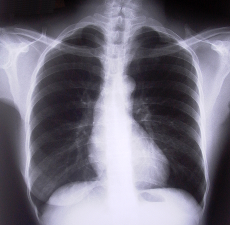Paranta Biosciences commences cystic fibrosis trial Paranta Biosciences commences cystic fibrosis trial