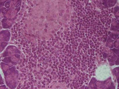 An early step in type 1 diabetes development