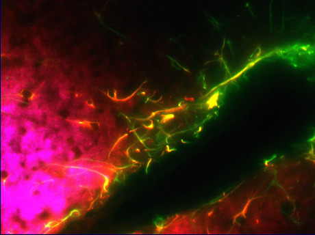 Chronic pain treatment with stem cells