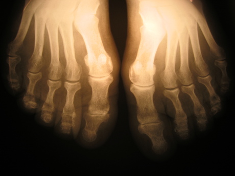 High-res bone scans without the radiation