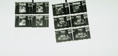 Perinatal risk factors for OCD Perinatal risk factors for OCD