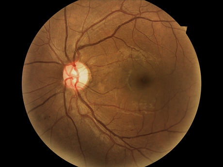 Eye-screening trial for diabetics Eye-screening trial for diabetics