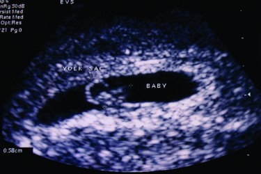 Ultrasound - The quiet achiever in medical imaging