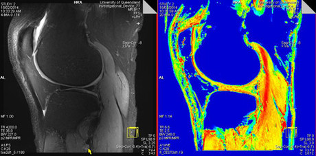 Southern Hemisphere's Most Powerful Body Scanner Now Operating at UQ