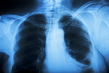 Are you genetically susceptible to lung disease?