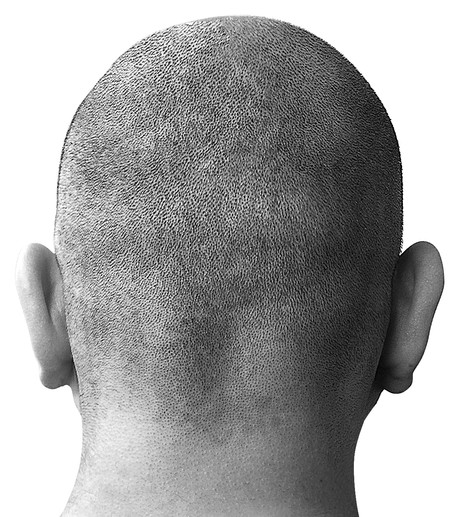 The genes that predict your risk of hair loss