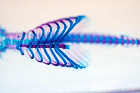 3D-printed sternum successfully implanted 3D-printed sternum successfully implanted