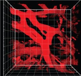 Two-step approach to improve pancreatic cancer survival rate Two-step approach to improve pancreatic cancer survival rate