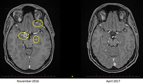 Australian researchers make melanoma breakthrough