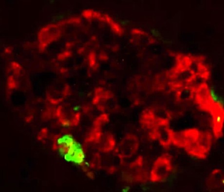 Misfolded pancreatic protein can induce symptoms of diabetes