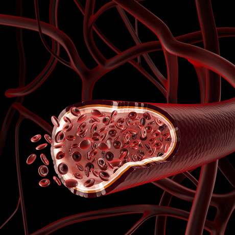 &#39;Stiffer&#39; blood vessels may increase risk of heart attack