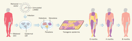 The boy with genetically modified skin