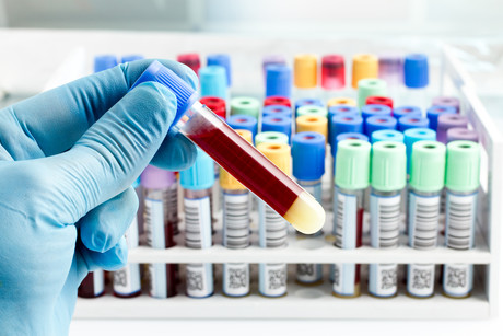 One blood test to screen for eight cancers One blood test to screen for eight cancers