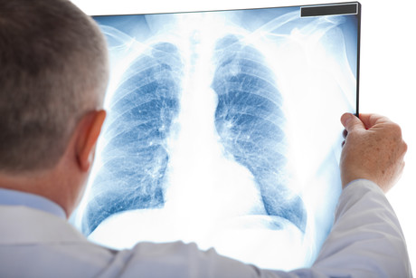Next-gen antibody shows promise as lung fibrosis treatment Next-gen antibody shows promise as lung fibrosis treatment