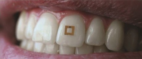 Track your eating habits with tooth-mounted sensors Track your eating habits with tooth-mounted sensors