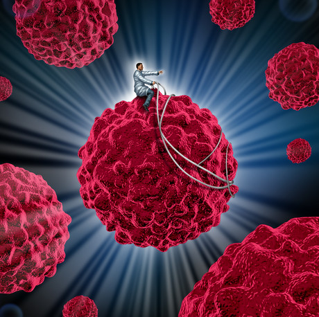 Lung cancer subtype responsive to immunotherapy Lung cancer subtype responsive to immunotherapy