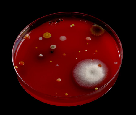 Penicillin allergy linked to greater risk of superbug infections