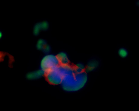 Blood test to predict the spread of head and neck cancer