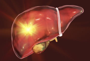 Ultrasound used to burst chemo-capsules inside liver tumours Ultrasound used to burst chemo-capsules inside liver tumours