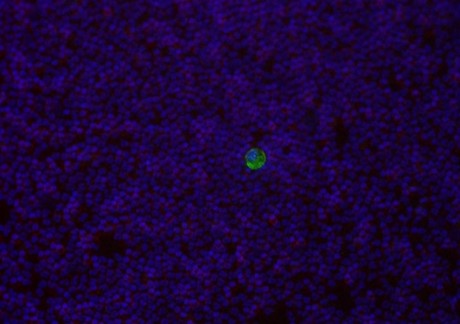 New method helps diagnose cancer with malaria protein New method helps diagnose cancer with malaria protein