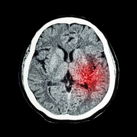 Stroke doubles dementia risk