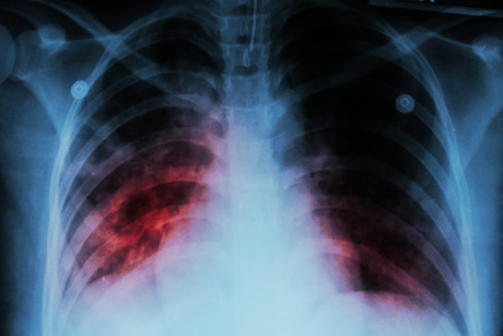 Flu-based vaccine can protect against tuberculosis