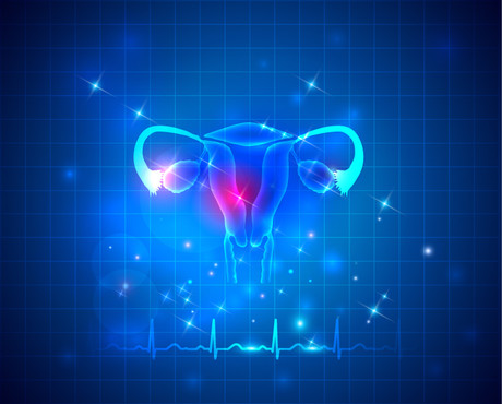 International guideline produced for polycystic ovary syndrome