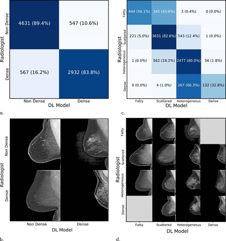 Using artificial intelligence to measure breast density