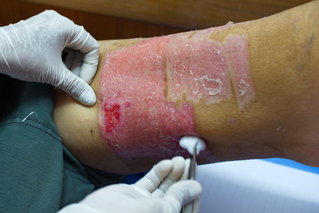 100% human skin graft developed