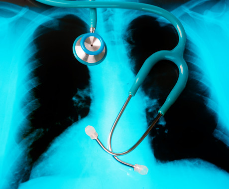 Minimally invasive lung cancer screening method