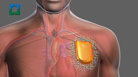 &#39;Antibiotic envelope&#39; cuts infection risk from cardiac devices