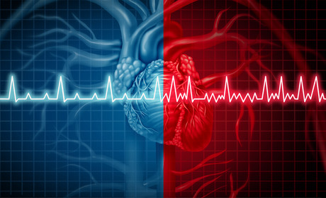 Atrial fibrillation is the new epidemic