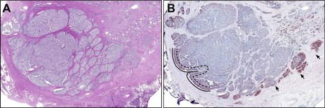Predicting and detecting metastasis in prostate cancer