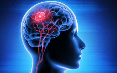 Cannabinoids could treat brain tumours