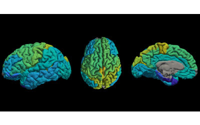 MRI technique shows molecular make-up of the brain