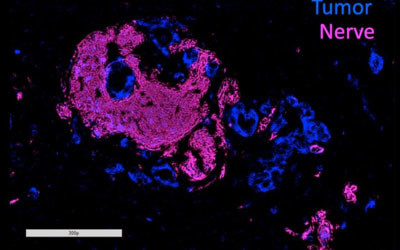 Preventing the spread of pancreatic cancer