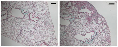 Genetic mutation found to cause pulmonary fibrosis Genetic mutation found to cause pulmonary fibrosis