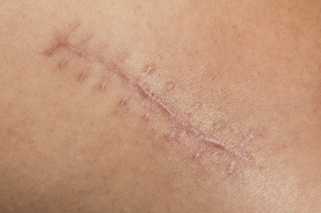 The challenge of treating scars The challenge of treating scars