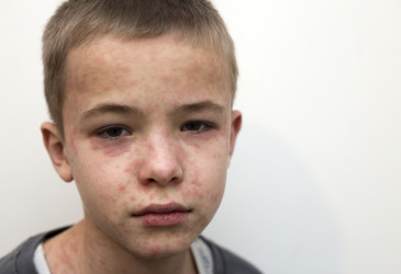 Measles wipes the immune system's memory Measles wipes the immune system's memory