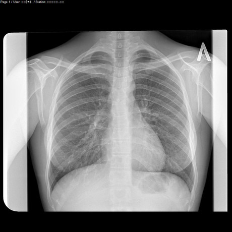 NSW Resources Regulator investigating possible dust disease cases