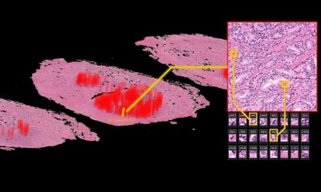 AI identifies new features associated with cancer recurrence