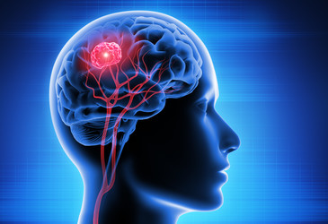 Brain imaging predicts benefit of liquid biopsy in glioblastoma