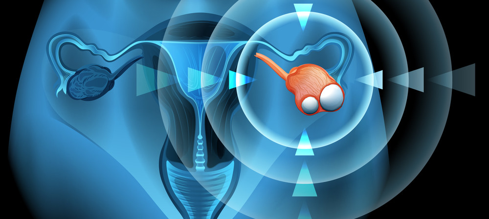 AI predicts which ovarian cancer treatment is best for each patient