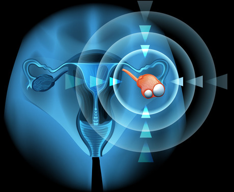 AI predicts which ovarian cancer treatment is best for each patient AI predicts which ovarian cancer treatment is best for each patient