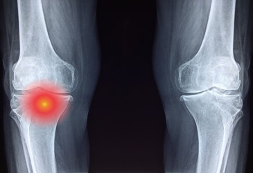 Increasing the visibility of prostate cancer cells in bone Increasing the visibility of prostate cancer cells in bone